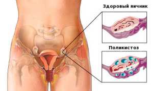 Синдром поликистозных яичников