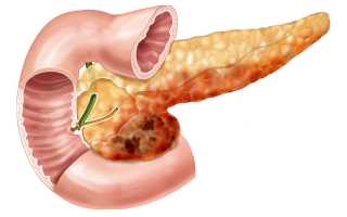 Лечебное голодание при панкреатите