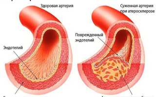 Опасное для жизни внутрижелудочковое кровоизлияние: почему возникает у детей и взрослых, шансы на спасение