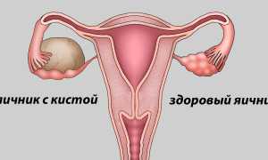 Что нельзя при кисте яичника?