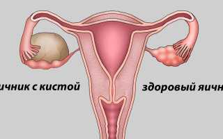 Что нельзя при кисте яичника?