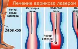 Почему развивается и как лечится варикоз у молодых