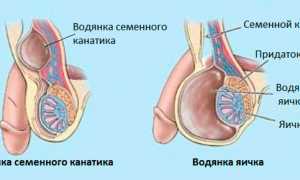 Лечение водянки яичек у мальчиков