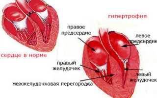 Гипертрофия левого желудочка сердца