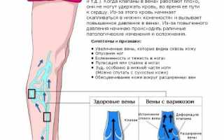 Где искать причину, если болят вены на ногах