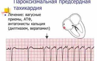 Иногда опасная, иногда нет, но обязательно требующая внимания тахикардия у подростков