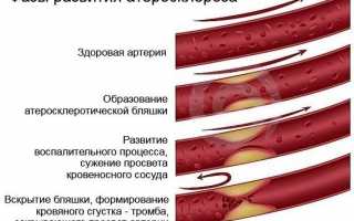 Основные признаки атеросклероза аорты