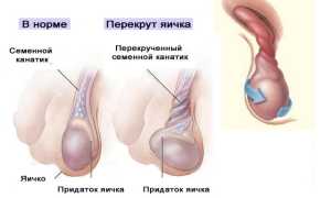 Перекрут яичка: причины, симптомы, последствия