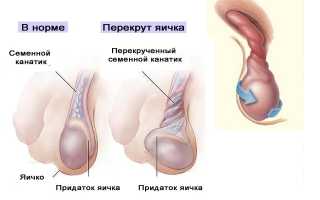 Перекрут яичка: причины, симптомы, последствия