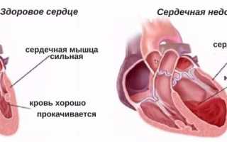 Основные осложнения инфаркта миокарда и меры по их предупреждению