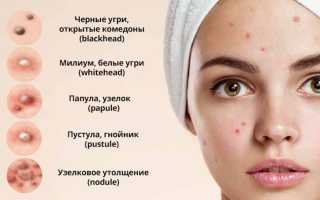 Гормоны и прыщи: лечение, анализы и профилактика