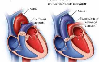 Насколько опасна транспозиция магистральных сосудов у малышей