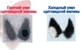 Горячие и холодные узлы щитовидной железы