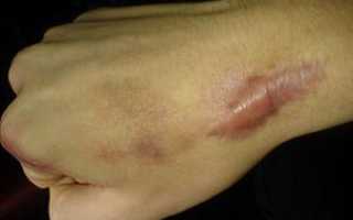 Что делать с коллоидными рубцами: способы лечения малоэстетичных образований