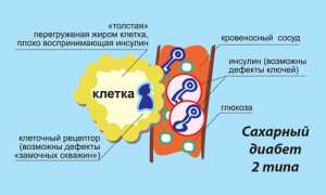 Признаки диабета 2 типа