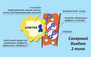 Признаки диабета 2 типа