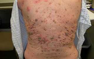 Причины появления кератоза кожи: консервативная терапия, народные средства и радикальные методы лечения
