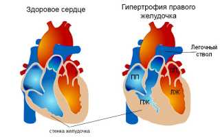 Результат повышенной нагрузки на сердце — гипертрофия правого желудочка