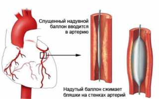 Кому, когда и зачем нужна баллонная ангиопластика