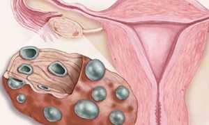 Киста яичника и беременность