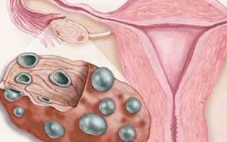 Киста яичника и беременность