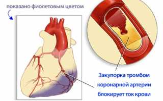 Вероятность возникновения инфаркта миокарда при сахарном диабете и последствия