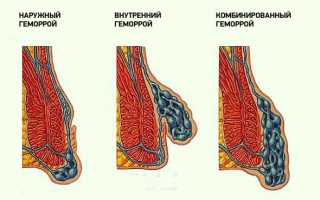 Домашнее и специализированное лечение геморроя при беременности