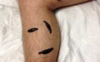 Где нашел применение в фармакологии гирудин пиявки