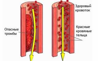 Профилактика образования тромбов и тромбофлебита