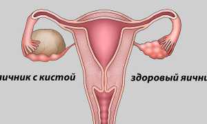 Причины возникновения кисты на яичнике