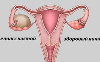 Причины возникновения кисты на яичнике