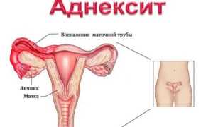 Хронический аднексит (сальпингоофорит)