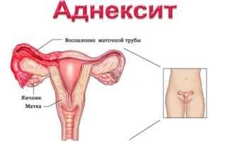 Хронический аднексит (сальпингоофорит)