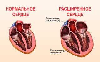 Всегда ли опасно увеличенное сердце, методы диагностики изменений и терапия