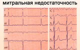 Насколько опасна регургитация митрального клапана, ее проявления и лечение