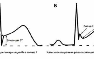 Иногда норма, а иногда и предвестник катастрофы — синдром реполяризации желудочков: что важно знать