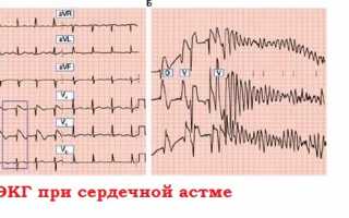Признаки сердечной астмы с отеком легких, первая помощь и прогноз