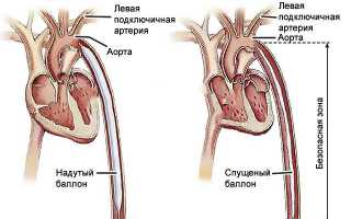 Когда и кому нужна баллонная контрпульсация, особенности ее проведения