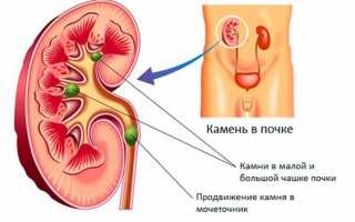 Как взаимодействуют камни в почках и давление