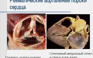 Опасный и трудно диагностируемый комбинированный порок сердца