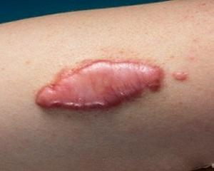 коллоидные рубцы фото