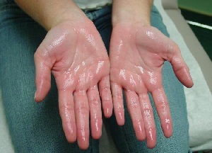 как лечить гипергидроз