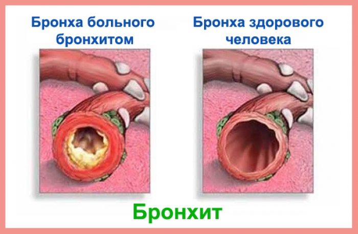 бронхит_народные средства