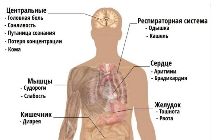 Кетоацидоз