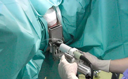 Биопсия простаты