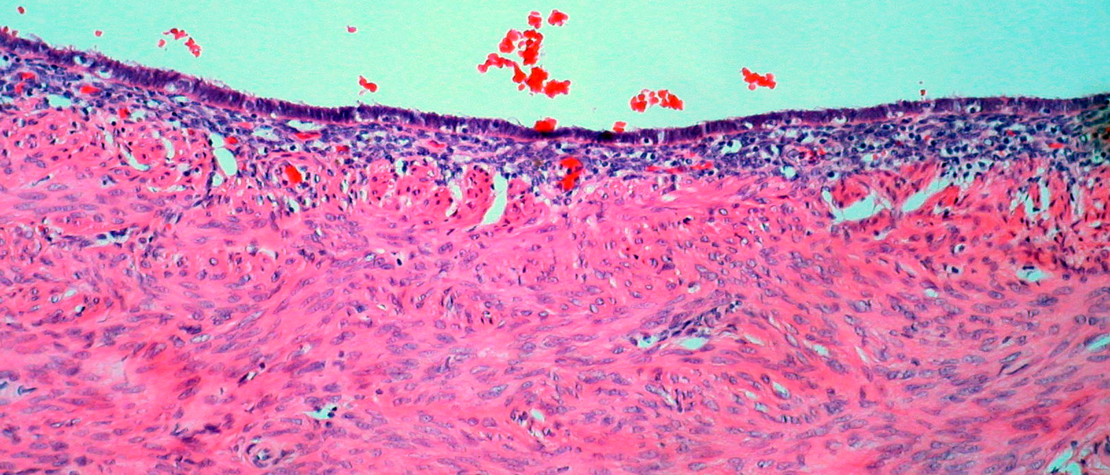 Эндометриоз фаллопиевой трубки