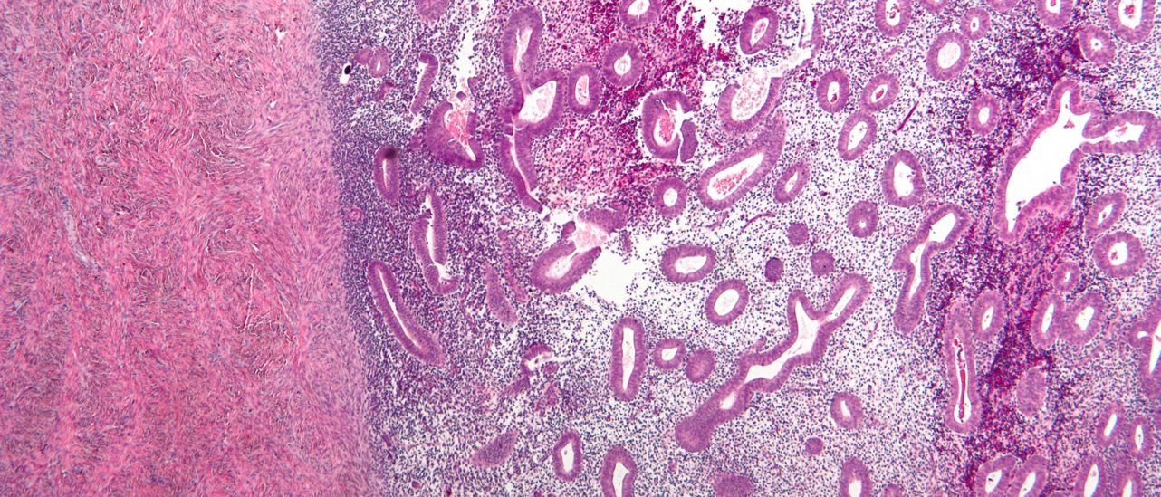 Эндометриоз яичника