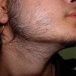 Гипертрихоз