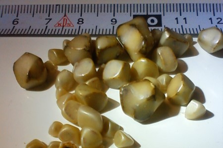 Камни из поджелудочной железы