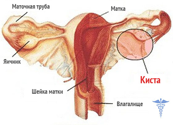 Киста яичника